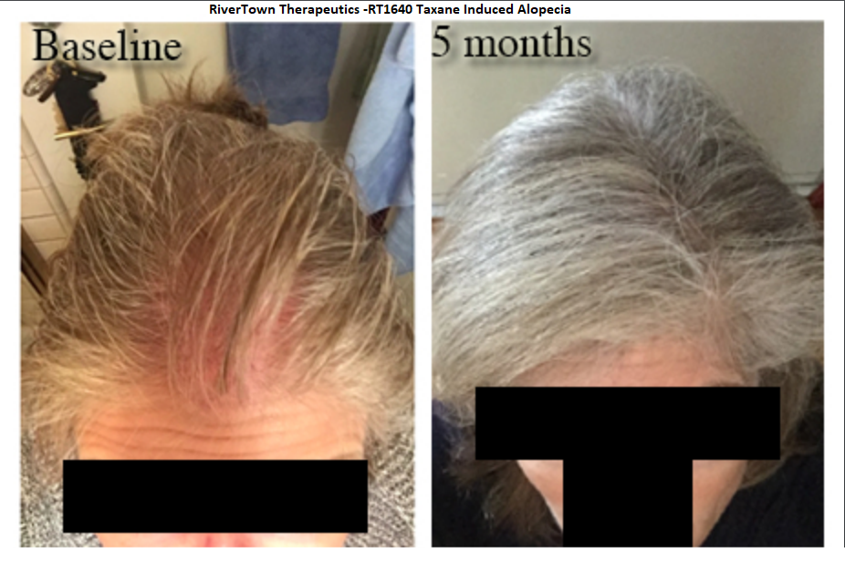 Permanent Chemotherapy-Induced Alopecia Reversal – Follicle Thought