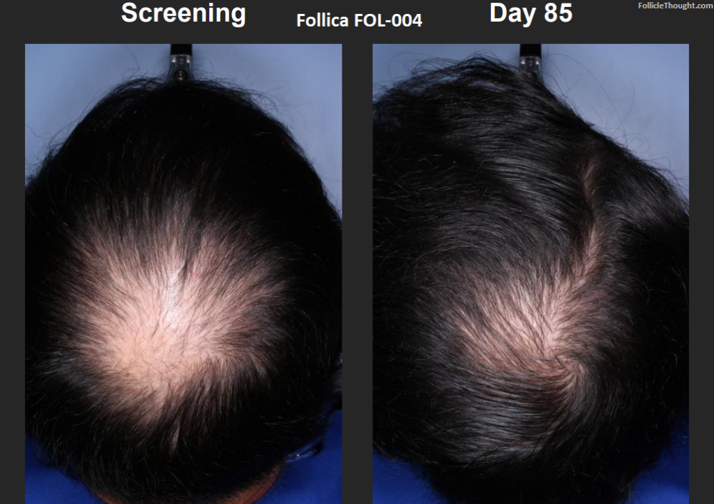 Follica_Hair_Results_Before_After_Close_Up - Follicle Thought