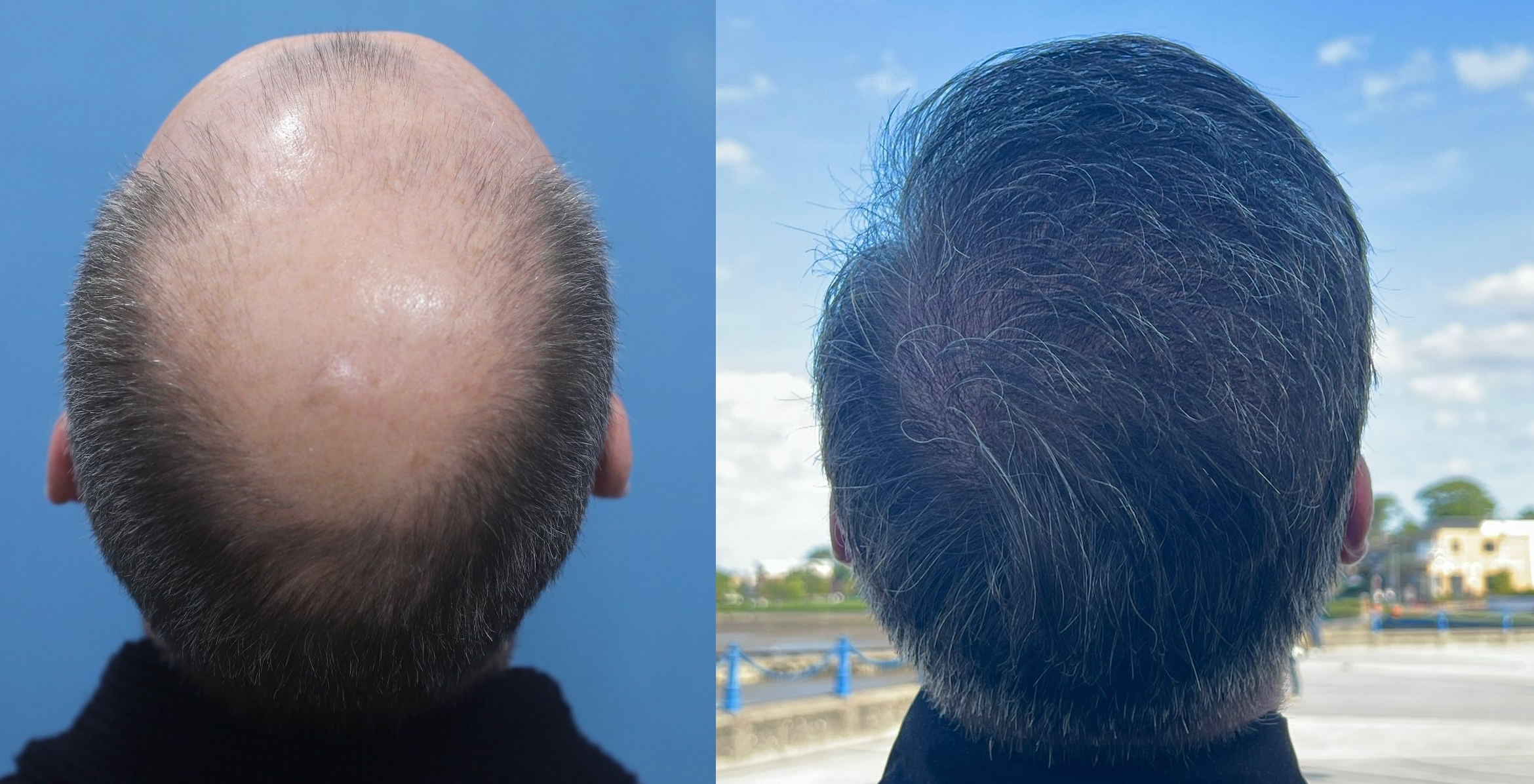 The Best Of Hair Transplants 2022 – Follicle Thought