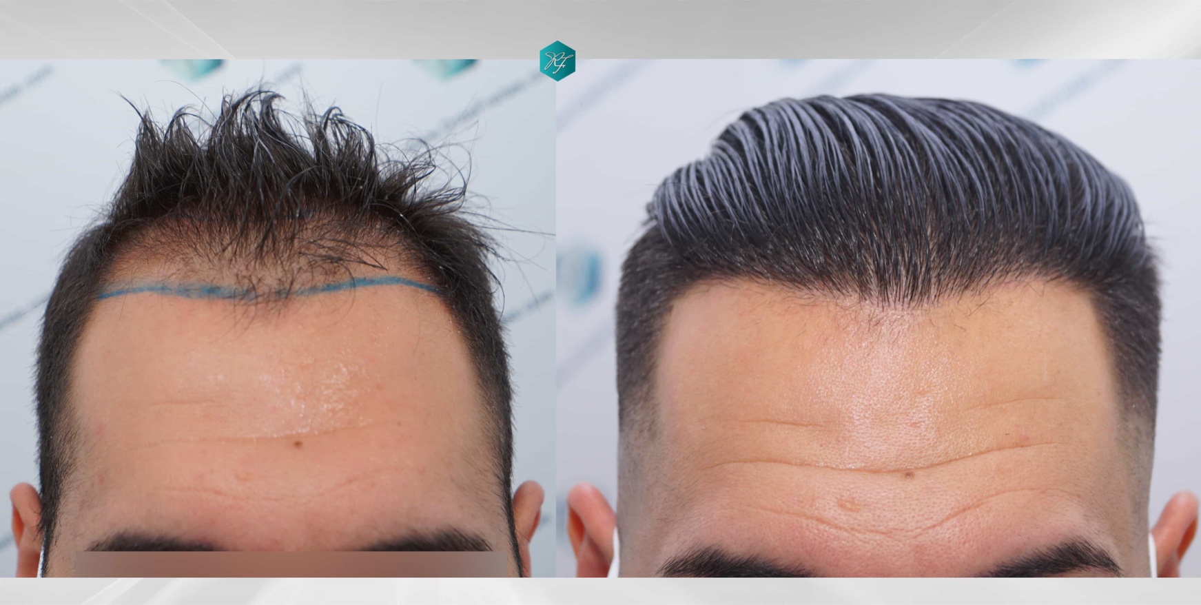 The Best Of Hair Transplants 2022 – Follicle Thought