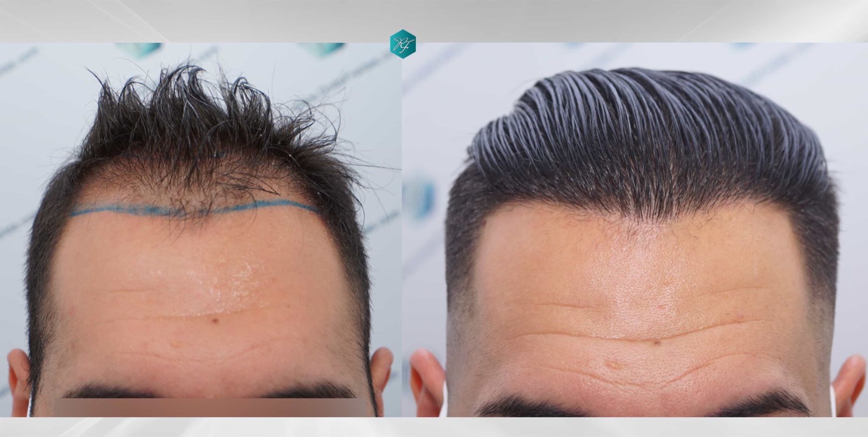 fue hair transplant near me