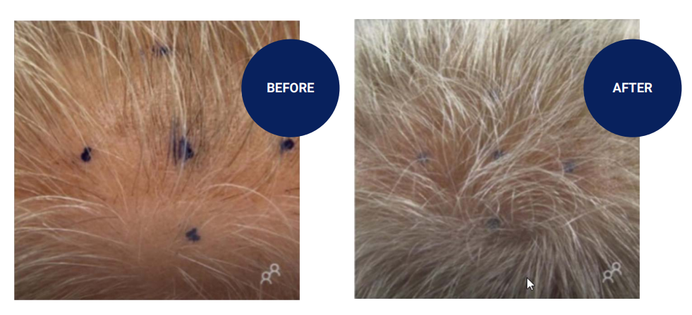 Alopecia Clinical Trial Forecast For 2023 – Follicle Thought