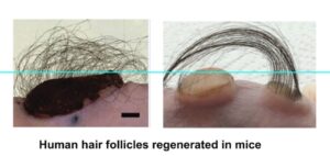 Photo of two images. Left: regenerated human hairs from one donor 6 months after grafting. Right: Another donor 12 months after grafting.